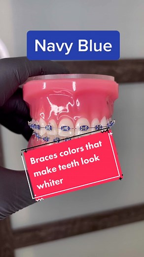 Best Braces Colors for Whiter Teeth