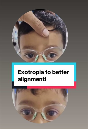 Achieve Better Alignment with Vision Therapy in Nepal