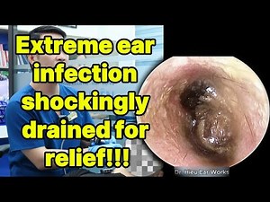 Extreme ear infection shockingly drained for relie | ear cleaning | ASMR earwax | soothing |relax|