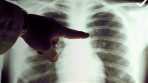 Tuberculosis, syphilis cases on the rise in Montreal