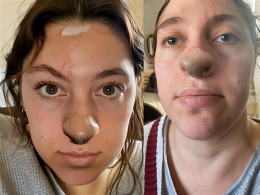 A woman was bitten on the nose by a dog, and after the wound healed, she noticed something unusual - hair started growing on her nose.👃🐈As time went on, the situation only got worse, and what happened to her face will leave you shocked.🔍😐What an unexpected and unfortunate turn of events - poor thing!😱😓Take a look at the photo in the comments below to see what happened.⬇️⬇️⬇️ | About Everything