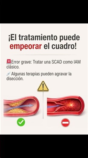 ¿IAM? Cuidado… podría ser SCAD (y tratarlo mal ⚠️)