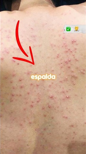 How to avoid back acne #glowup #men