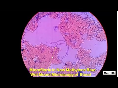 Microfilaria in blood Microscopy