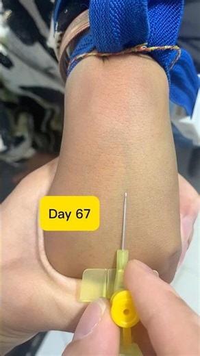 How to Insert a 24G Yellow IV Cannula Perfectly! | Day 67 Clinical Skills#shortvideo #shorts #safi