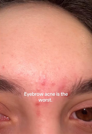 Eyebrow Acne: Tips and Skincare Advice