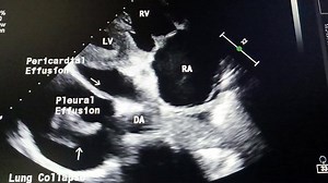 🫀📡 Transthoracic Echocardiography – RV Inflow View What can this single view teach you? 👀 👉 Pericardial effusion vs pleural effusion 👉 Landmark: descending aorta 🧭 👉 Associated lung collapse 🌬️ One view… multiple diagnoses. Echo is all about anatomy logic 🧠✨ | Ahmed Mohsen