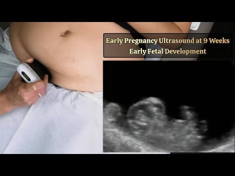 Early Pregnancy Ultrasound at 9 Weeks | Growing Fetus (Early Fetal Development)