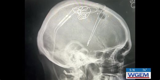 Long term relief for dystonia sufferers