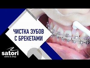 Чистка зубов с брекетами. Чистите с нами каждый день.