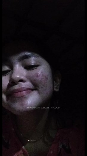 mary elizabeth r skin care acne journey