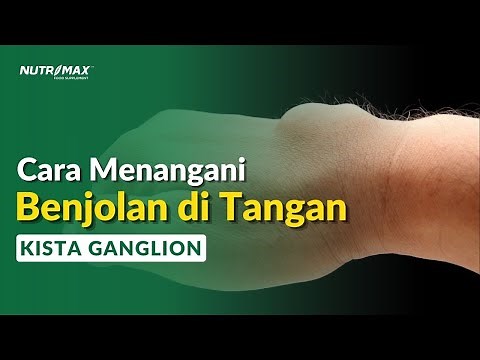 How to Treat a Lump on Your Wrist? Ganglion Cysts