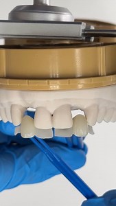 Double Lateral Maryland Bridges! Case from Dr. Colleen Chambers in Massachusetts! | CEO Luke Kahng