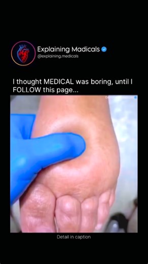 Medical | Health | Anatomy on Instagram: "A visibly prominent dorsalis pedis pulse can signal underlying vascular or cardiac changes. In some cases, it reflects fluid overload or elevated central venous pressure, commonly seen in right-sided heart failure or congestive heart failure (CHF). Increased venous pressure causes blood to pool in peripheral vessels, making pulses appear exaggerated. Clinically, this finding should never be assessed in isolation. Doctors evaluate both feet for symmetry, 