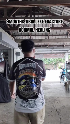 9-Month Tibia Fracture Healing Process