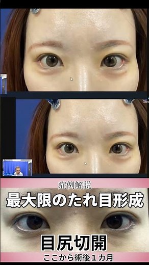 目尻切開、グラマラスライン、垂れ目形成。手術後1ヶ月の症例解説