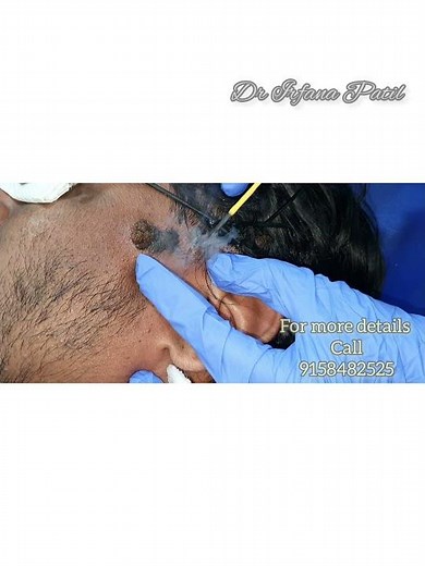 #birthmarkremoval#nevus #surgery #dermatologist