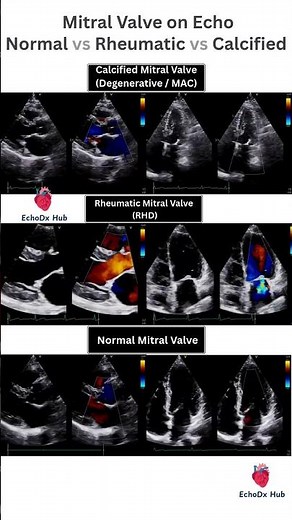 Mitral Valve on Echo: Normal vs Rheumatic vs Calcified #echocardiography