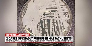 Superbug Candida auris found in Massachusetts and more than half of U.S. states