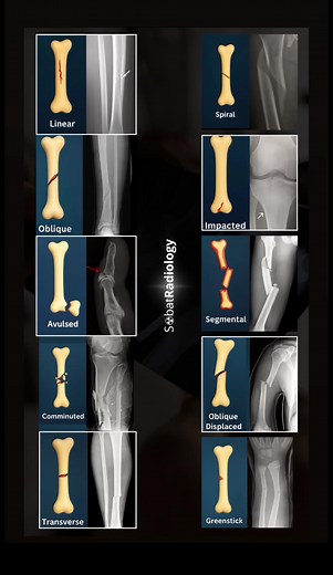 Common Bone Fracture Classifications: Quick Radiology Guide