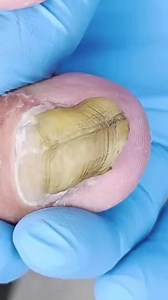 The reveal under this toenail is too shocking 4I43 Beautiful moments of care and relaxation through a gentle pedicure experience. Simple, clean, and satisfying. 🌿✨ Disclaimer: This video is for educational and relaxation purposes only. All content belongs to the respective owners, no copyright infringement is intended. | Marcia Villa