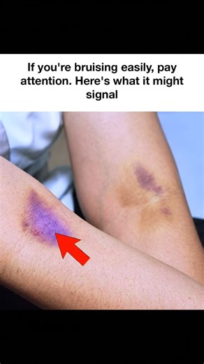 353K views · 878 reactions | If you're bruising easily, pay attention. Here's what it might signal | Health Tips Tricks | Facebook