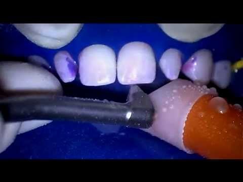 The Bioclear Blaster - Efficient Biofilm Removal