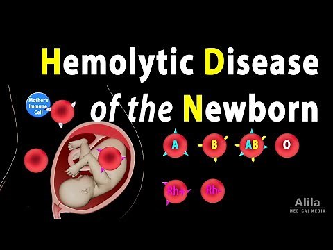 Hemolytic Disease of the Newborn (HDN), Animation