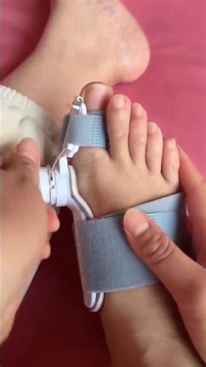 Toe Correction Device | Fix Bent Toes Naturally #sickcare