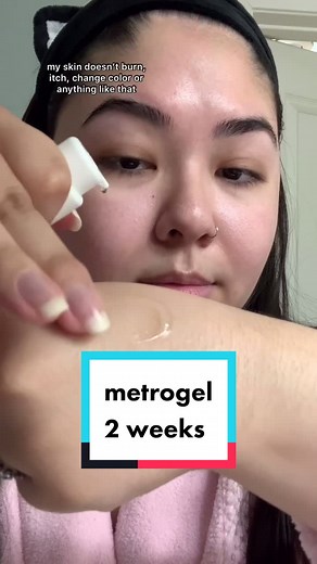 Rosacea Treatment with Metronidazole Gel | Skincare Tips