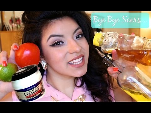 5 Home Remedies to get Rid of Burn Scars/Marks
