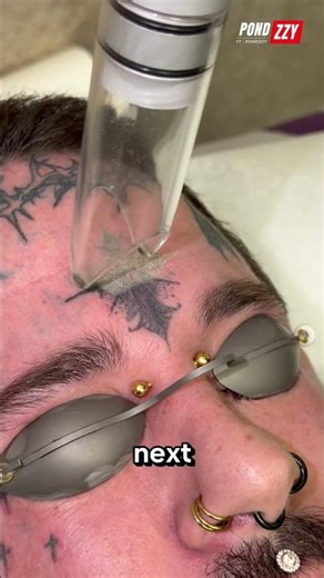 Why This Clear Gel Makes Tattoo Removal Much Faster! 🚨