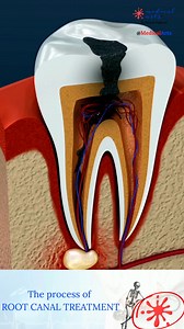 4.1M views · 11K reactions | Disclaimer: root canal therapy is not as painful as this video sounds. Each year, millions of teeth are saved globally through root canal treatment, preventing the need for extractions. #rootcanaltreatment #rootcanal #medicalarts #medicalart | Medical Arts | Facebook