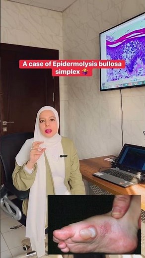 Epidermolysis bullosa simplex #dermatology