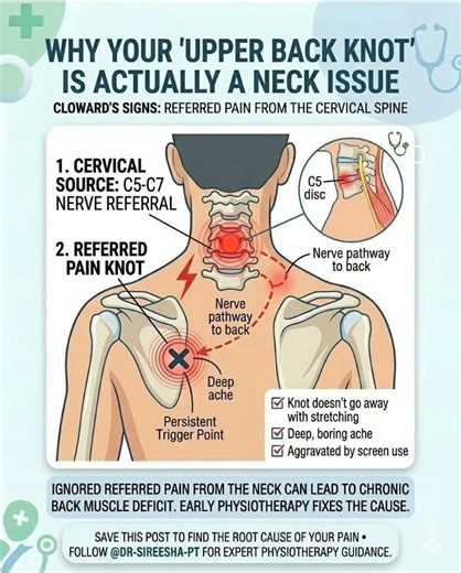 Upper back knot? It may come from neck nerve irritation (C5–C7). Poor posture and screen use effects
