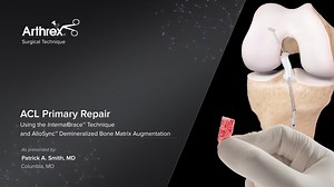 ACL Primary Repair With InternalBrace™ Ligament Augmentation and AlloSync™ Demineralized Bone Matrix Augmentation