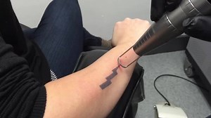 66K views · 94 reactions | Recent advancements in technology have made laser tattoo removal more effective, quicker and less painful! Share this video for a chance to win a $100, $200, or $400 gift certificate. Winners will be chosen at random on Friday July 15th. You can receive a free price quote by calling 724-972-7734 or by visiting www.disappearinginkltr.com | Disappearing Ink, Laser Tattoo Removal | Facebook