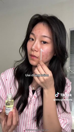 Effective Acne Treatment Methods You Should Try