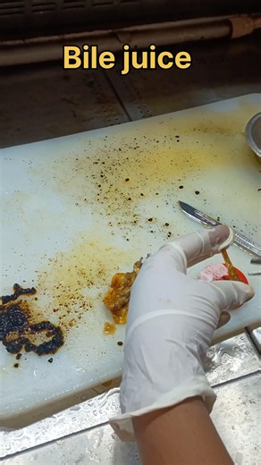 bile juice from gall bladder specimen| #histopathology #histomuseum #gallbladder #gallbladderdisease