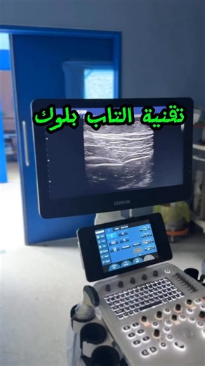 Ahmed Shihab Ahmed on Instagram‎: "تقنية TAP Block تحت دلالة# السونار (Transversus Abdominis Plane Block) يُعد TAP Block من أهم تقنيات التخدير الموضعي الحديثة المستخدمة لتخفيف الألم بعد جراحات البطن، خاصة عند تطبيقه باستخدام جهاز السونار لما يوفره من دقة وأمان عالٍ. تعتمد هذه التقنية على حقن المخدر الموضعي في المسافة الواقعة بين عضلتي Internal Oblique و Transversus Abdominis، حيث تمر الأعصاب المسؤولة عن الإحساس بجدار البطن الأمامي. 🎯 فوائد استخدام السونار في TAP Block: ✅ تحديد الطبقات العضلية ب