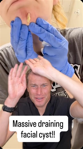 Austin Lee, PA-C | Medical and Cosmetic Dermatology on Instagram: "Poor girl has a massive facial cyst! #fyp #cyst #pimple #explosion #skin"