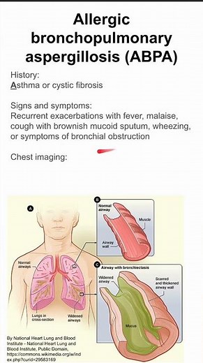Allergic bronchopulmonary aspergillosis (ABPA)