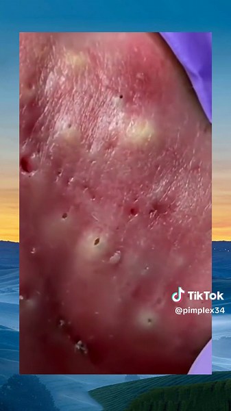 popping foryou satisfying pimpe accne pimplepop squeeze (173)