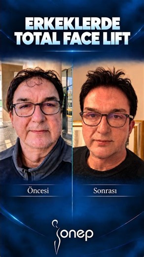 Erkeklerde de doğal ve dengeli sonuçlar! Total Face Lift - #onep #beforeandafter