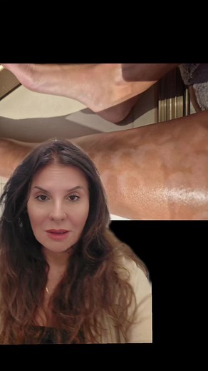 Hypopigmentation: Causes and Treatment Options