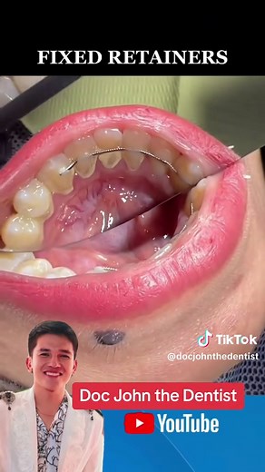 Understanding Fixed Retainers in Orthodontics