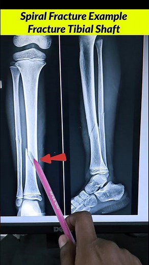 Spiral Fracture ? Leg bone tibia ka fracture #radiographerusn #xray