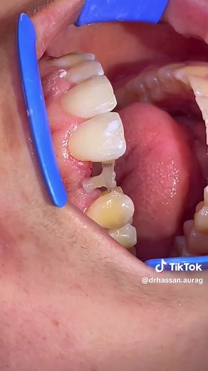 Replacing Congenitally Missing Lateral Incisor with Direct Resin Bonded Bridge