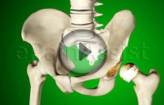 Watch How Hip Replacement Surgery is Performed - Epainassist - Useful Information for Better Health