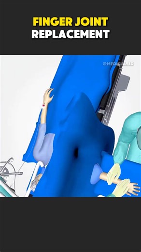 Finger Joint Replacement Surgery #pipjoint #fingerjoint #fingersurgery #fingerarthritis #fingerjointreplacement | Life Health.